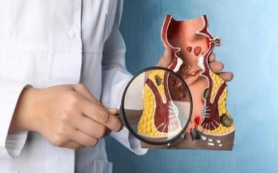 Phương pháp Thắt búi trĩ ngoại là gì ? Địa chỉ uy tín hiện nay