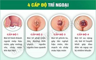 Trĩ ngoại có nguy hiểm không và chữa bằng cách nào hiệu quả ?