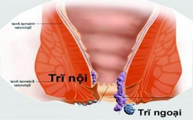 Trĩ nội và trĩ ngoại cái nào nặng hơn ? 3 cách chữa hiệu quả 2025