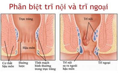 Trĩ nội trĩ ngoại khác nhau như thế nào và phân biệt bằng cách nào ?