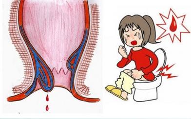 Bệnh trĩ nội đi ngoài ra máu có nguy hiểm hay không ?