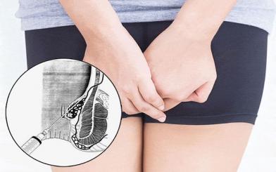 Tiêm xơ trĩ bằng dụng cụ nội soi có hiệu quả hay không ?