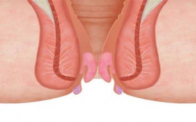 Thắt búi trĩ nội là gì? quy trình, hiệu quả và lưu ý quan trọng
