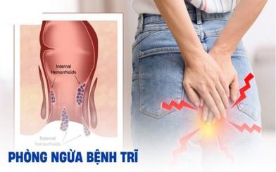 Những cách phòng ngừa bệnh trĩ nội hiệu quả đơn giản dễ thực hiện