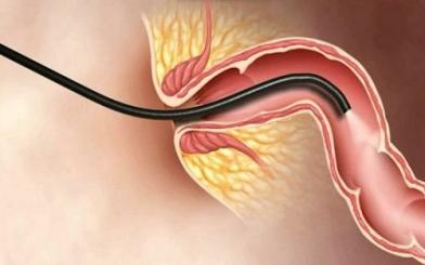 Bị trĩ có thể nội soi đại tràng được không? Giải đáp thắc mắc về phương pháp điều trị