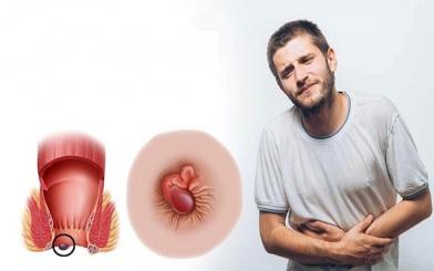 Trĩ nội có đau không ? nguyên nhân, triệu chứng và cách điều trị