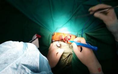 Mổ áp xe cạnh hậu môn : Quy trình, chi phí và thời gian hồi phục