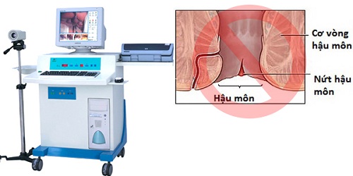 Điều trị bệnh trĩ bằng phương pháp HCPT2