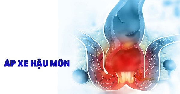Tìm hiểu kỹ về bệnh áp xe hậu môn