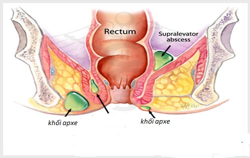 Nứt kẽ hậu môn không được điều trị sớm dẫn đến apxe hậu môn