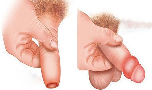 Bao quy đầu bị sưng phồng lên như cục mỡ do mụn rộp sinh dục