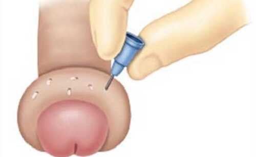 Bao quy đầu bị sưng phồng như cục mỡ
