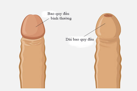 Bao quy đầu là gì?