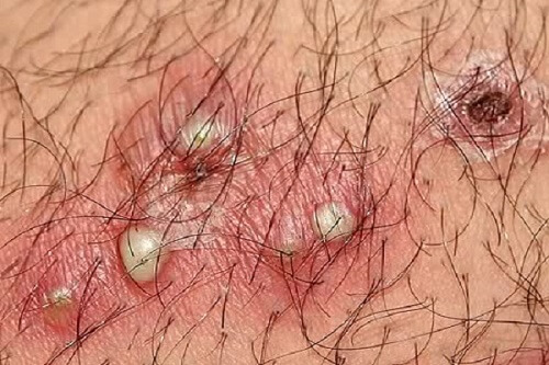 Bao quy đầu nổi mụn nhỏ cảnh báo nhiều bệnh nguy hiểm