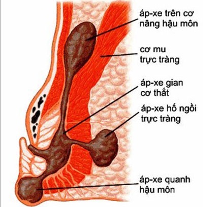 Biểu hiện bệnh áp xe hậu môn