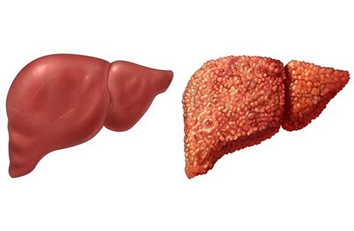 Bệnh gan- Nguyên nhân dẫn đến yếu sinh lý ở nam giới!