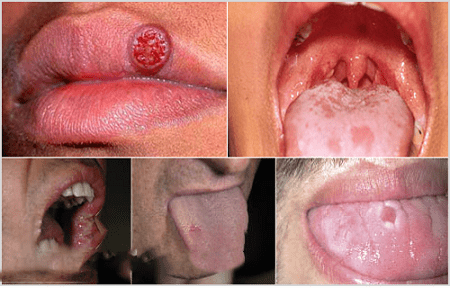 Ảnh hưởng tiêu cực nếu không kịp thời chữa bệnh giang mai ở miệng