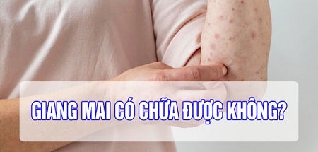 Giải đáp từ chuyên gia: Bệnh giang mai có chữa được không ?