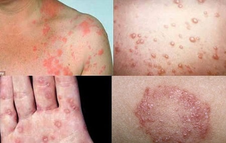 Bệnh giang mai có lây không? 