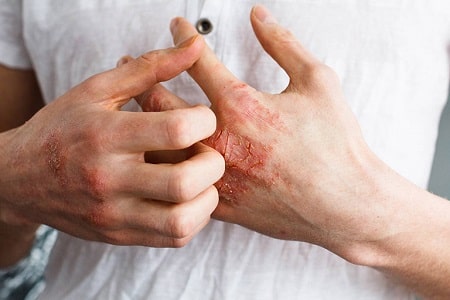 4 đối tượng có nguy cơ mắc bệnh giang mai cao 