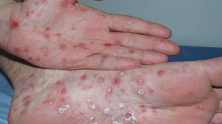 Bệnh giang mai – những thông tin cơ bản cần biết