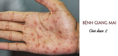 Bệnh giang mai giai đoạn 2 cùng những biểu hiện của bệnh