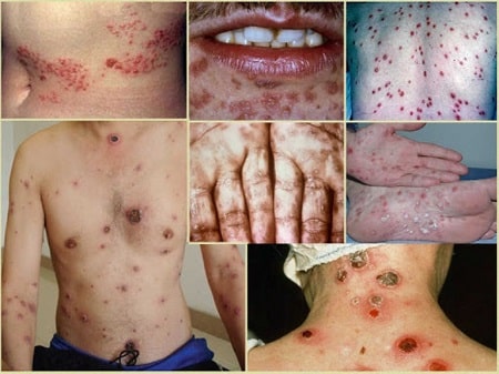 Tìm hiểu về giang mai giai đoạn 3