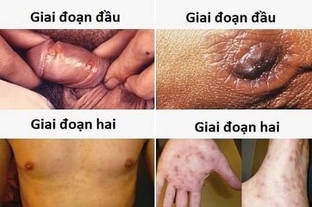 Các giai đoạn phát triển của bệnh giang mai