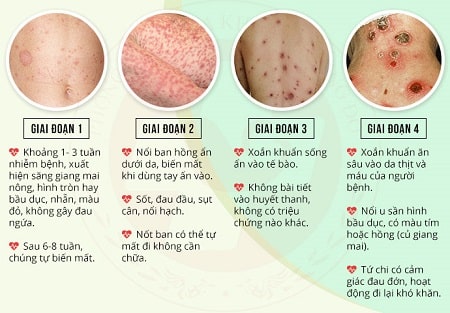 Bệnh giang mai nam giai đoạn đầu có nguy hiểm hay không ?