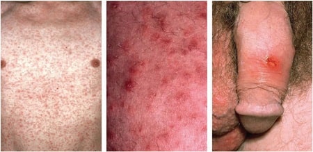 Bệnh giang mai nam giai đoạn đầu lây truyền qua những con đường nào ?