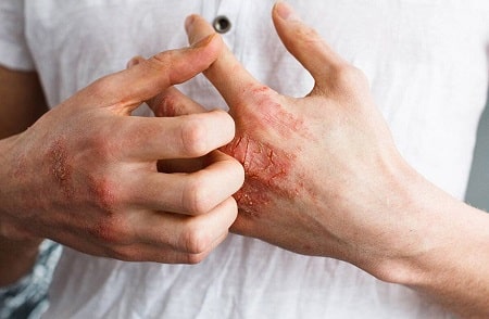 Những triệu chứng quả giang mai qua từng giai đoạn anh em nên biết