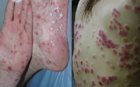 Nữ giới mắc bệnh giang mai có những biểu hiện như thế nào ?