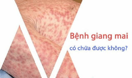 Bệnh giang mai nữ có chữa được không, chữa bằng cách nào?