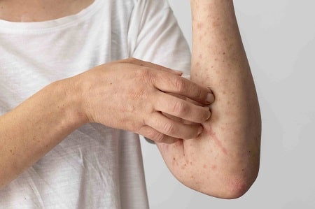 Những dấu hiệu để phát hiện bệnh giang mai ở nữ giới