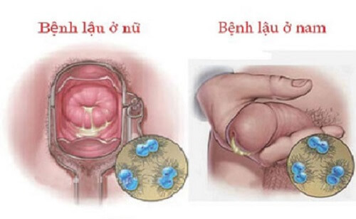 Bệnh lậu gây viêm niệu đạo