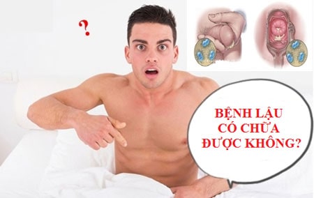 Bệnh lậu có chữa được không ? Phương pháp chữa hiệu quả