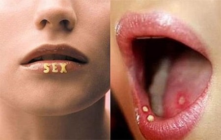 Bệnh lậu có lây qua đường miệng bằng những cách nào?