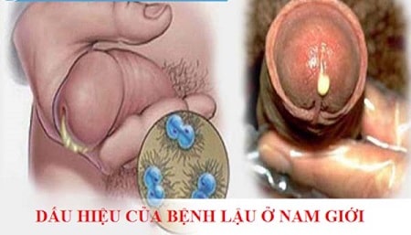 Lậu là bệnh như thế nào?