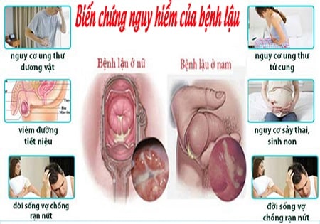 Bệnh lậu không chữa có sao không?
