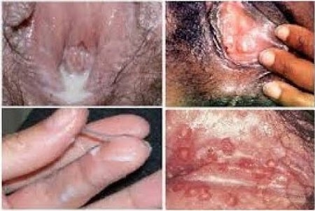 Dấu hiệu bệnh lậu giai đoạn đầu của nữ giới