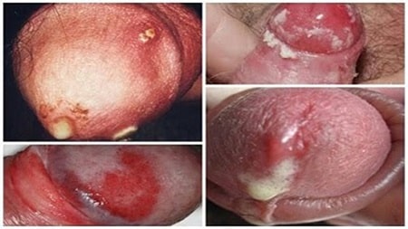 Thông tin khái quát về bệnh lậu