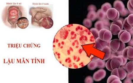 Triệu chứng bệnh lậu mãn tính là gì?