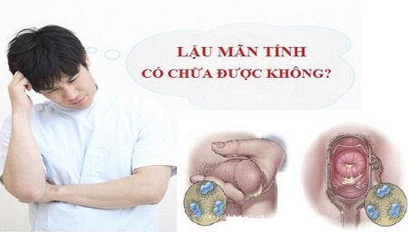 Bệnh lậu mãn tính có chữa khỏi được không?