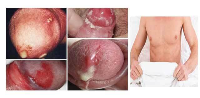 Bệnh lậu