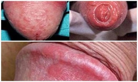 Bệnh lậu ở nam giai đoạn đầu
