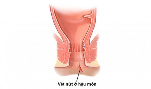 Biểu hiện bệnh nứt kẽ hậu môn