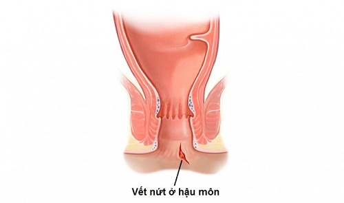 Hiện tượng nứt kẽ hậu môn nhẹ