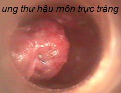 Ung thư trực tràng