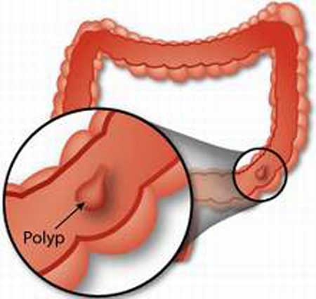 Hình ảnh khối polyp hậu môn