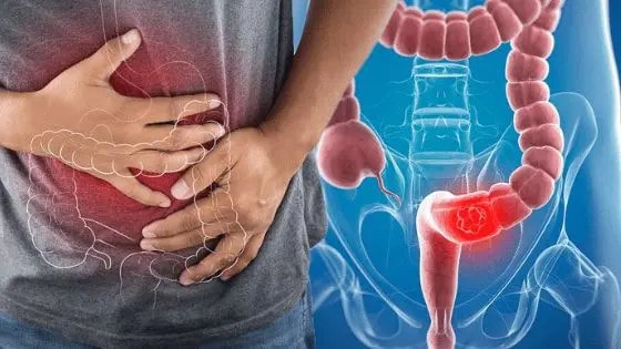  Tăng nguy cơ mắc ung thư đại trực tràng